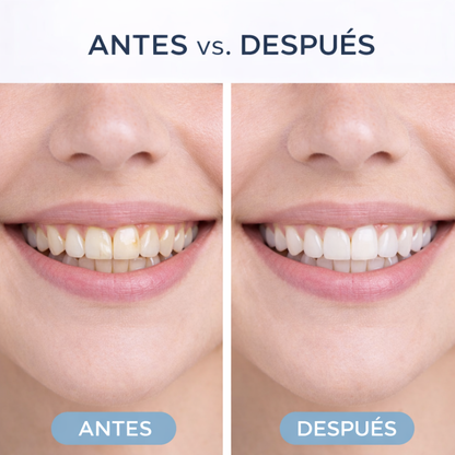 comparación antes y después del blanqueamiento dental con carbón activado natural
